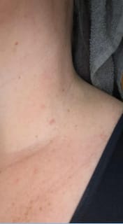 Customer photo review of Painless Skin Tag Removal Kit
