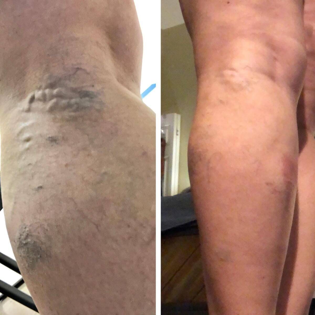 Customer photo review of VénaCare