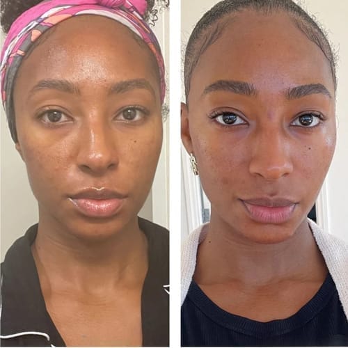 Customer photo review of Nuvetra Lymphatic Face Brush