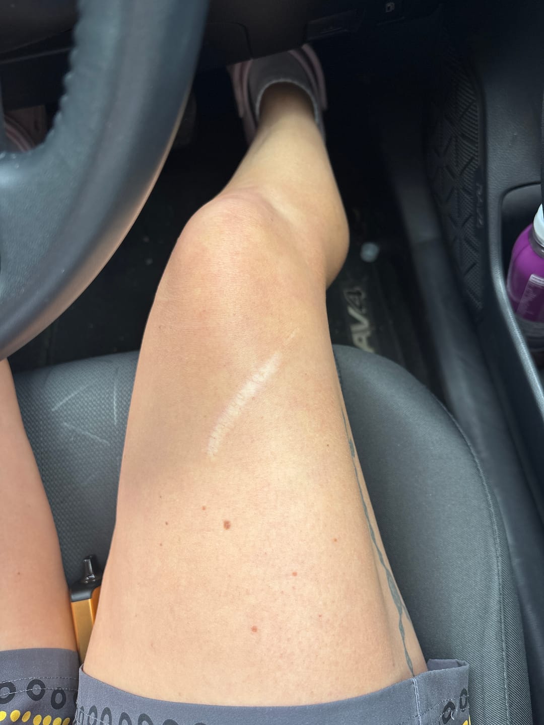 Customer photo review of Ultra Dark Tanning Foam