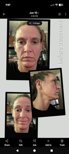 Customer's before treatment photo collage showing facial skin, prior to using Deep Collagen Cream.