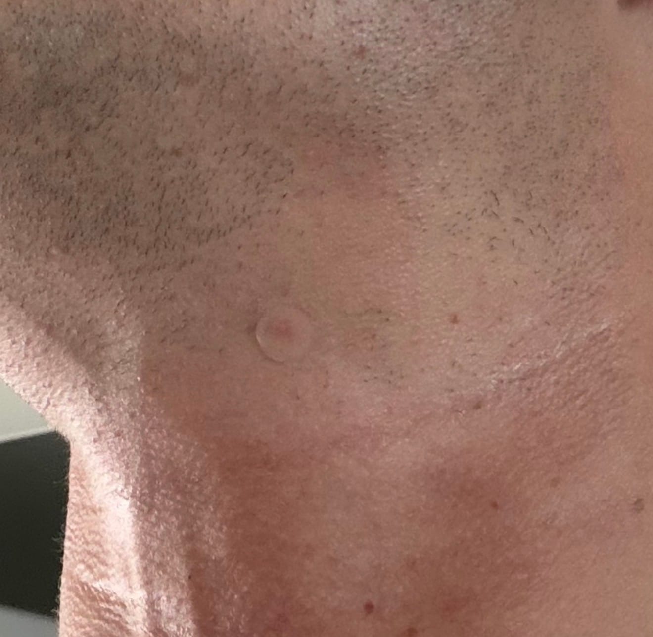 Customer photo review of JAWLINER Pimple Patch