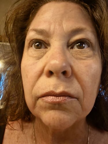 Customer's face showing results after using the Microneedling Infusion System.
