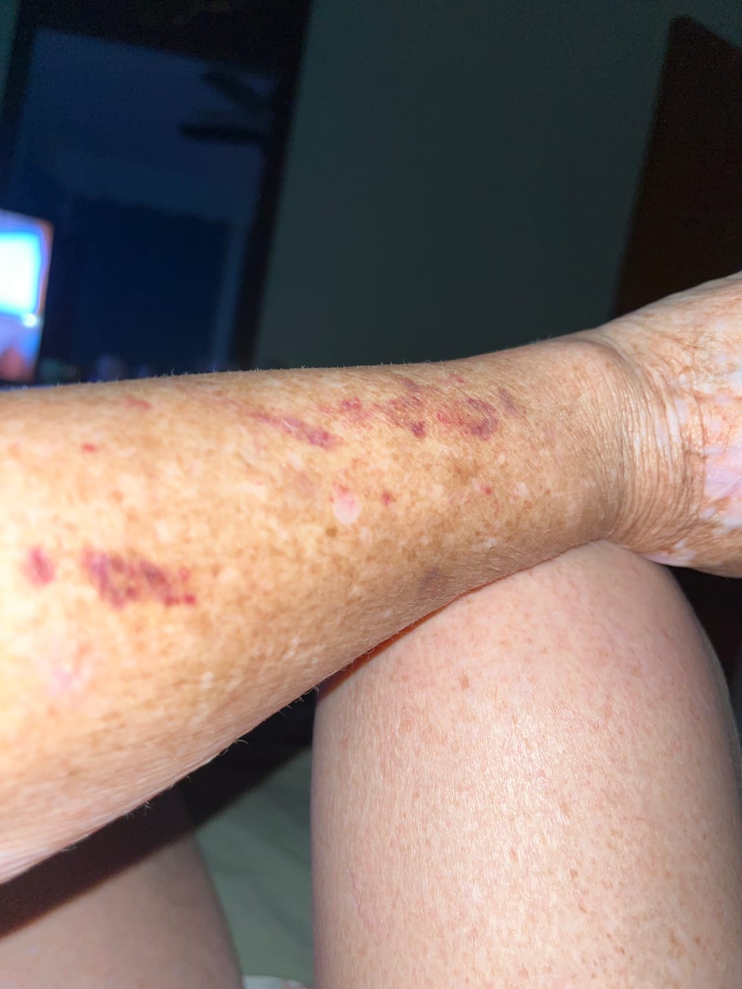 Customer photo review of Purpurex® Daily Supplement for Bruising 60 Capsules