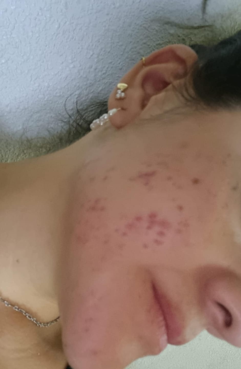 Customer photo review of A CONTROL - ACNÉ HORMONAL & RESISTENCIA A LA INSULINA