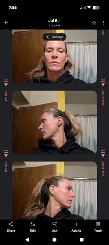 Customer's progress collage showing a person's facial skin texture before and during Seranova Micro Infusion treatment.