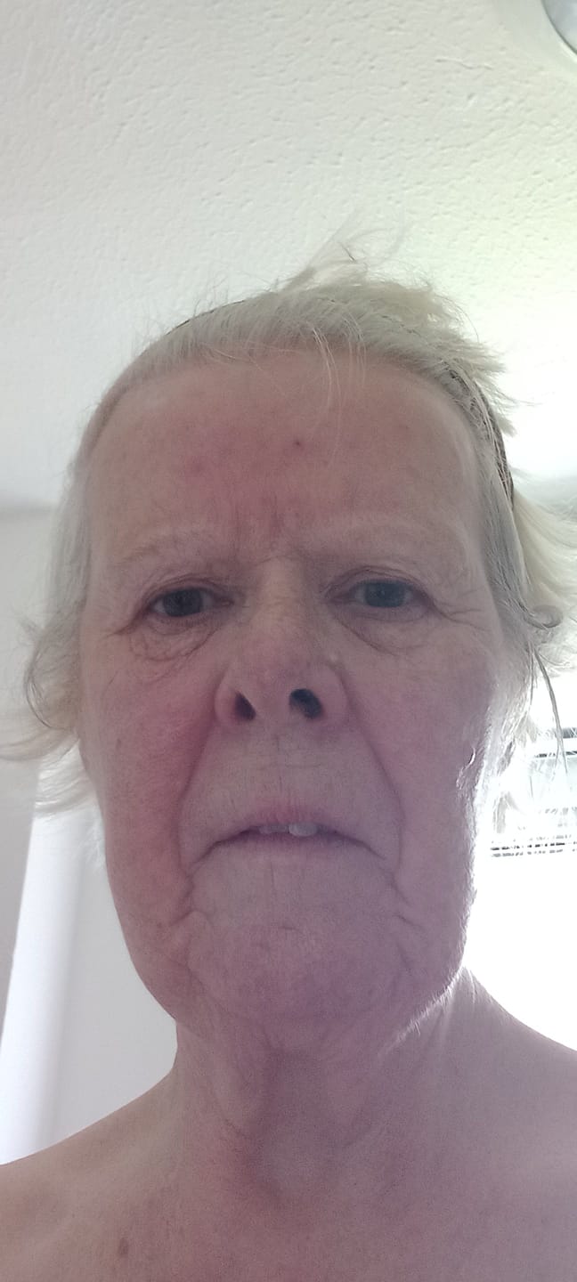 Customer photo review of Rosalique 3 in 1 Anti-Redness Miracle Formula SPF50