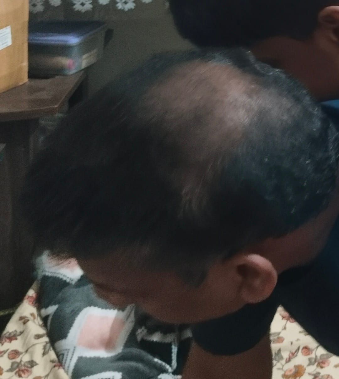 Customer photo review of Advance Hair Growth Serum 2.0 (30ml)