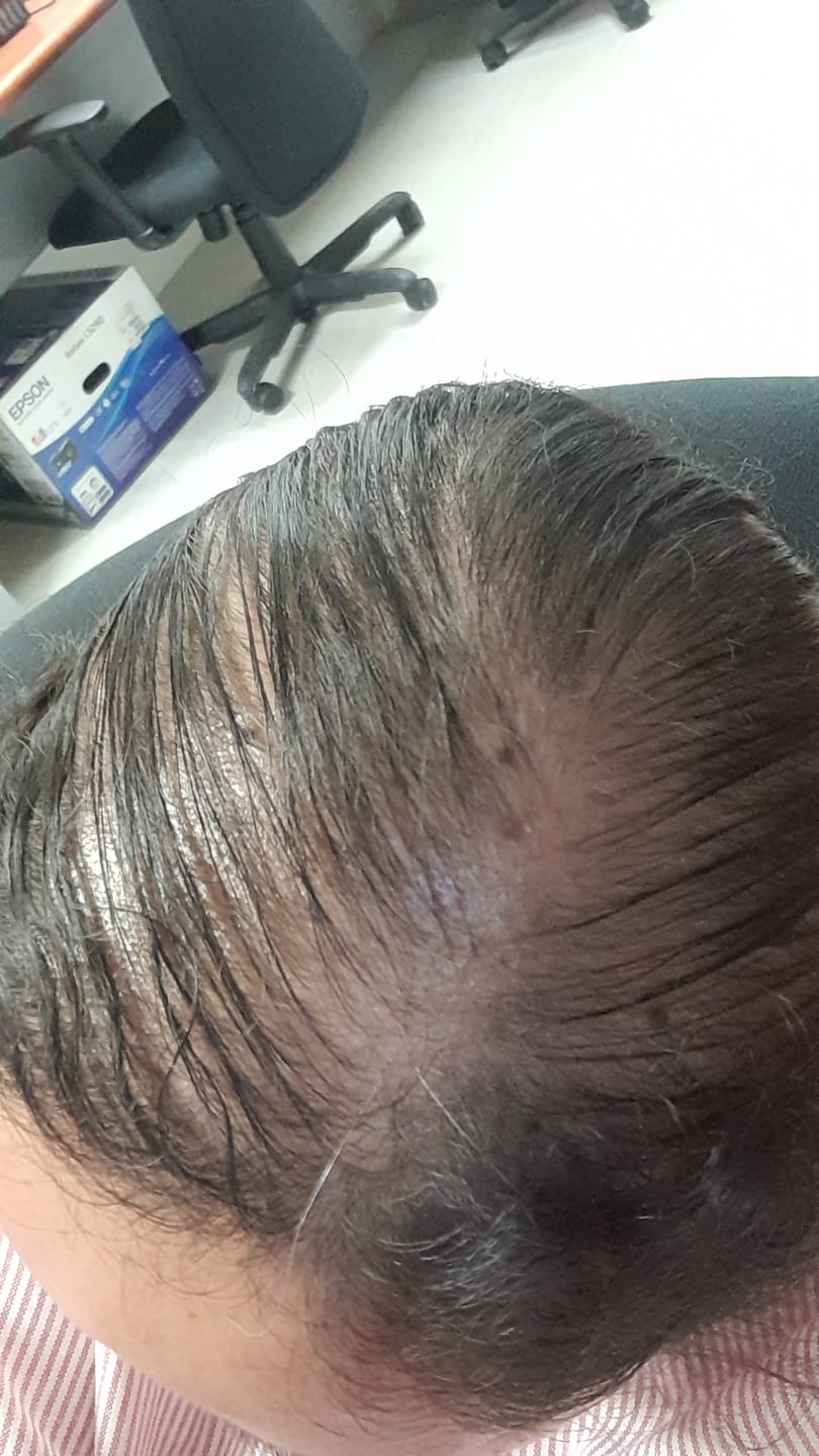 Customer photo review of Hair Fall Defense Rosemary & Mint with Keratin Cica & Collagen Shampoo Bar