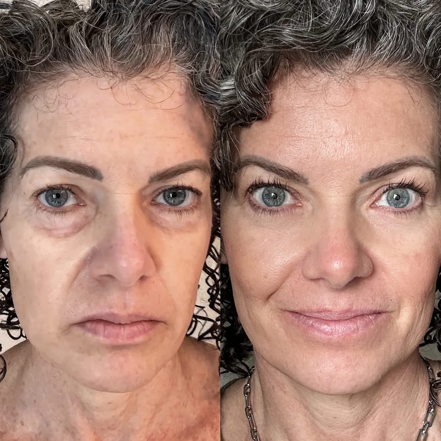 Customer photo review of LUMIN EYE™ Rotlicht & EMS Brille