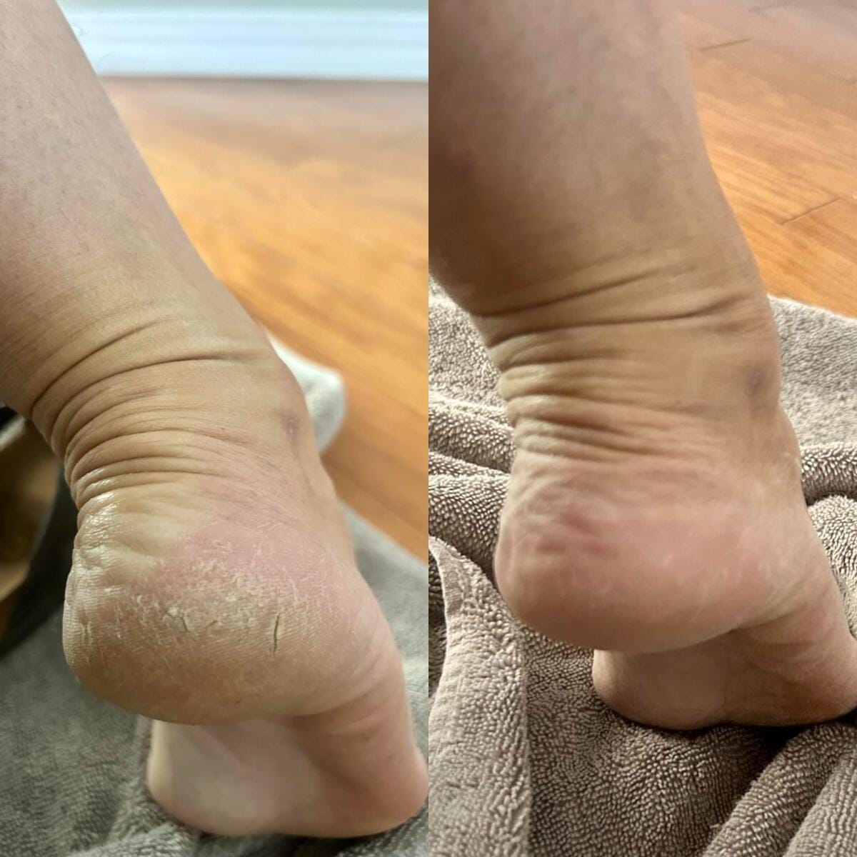 Customer photo review of Valanea SilkSmooth Pro™ Electric Foot Callus Remover