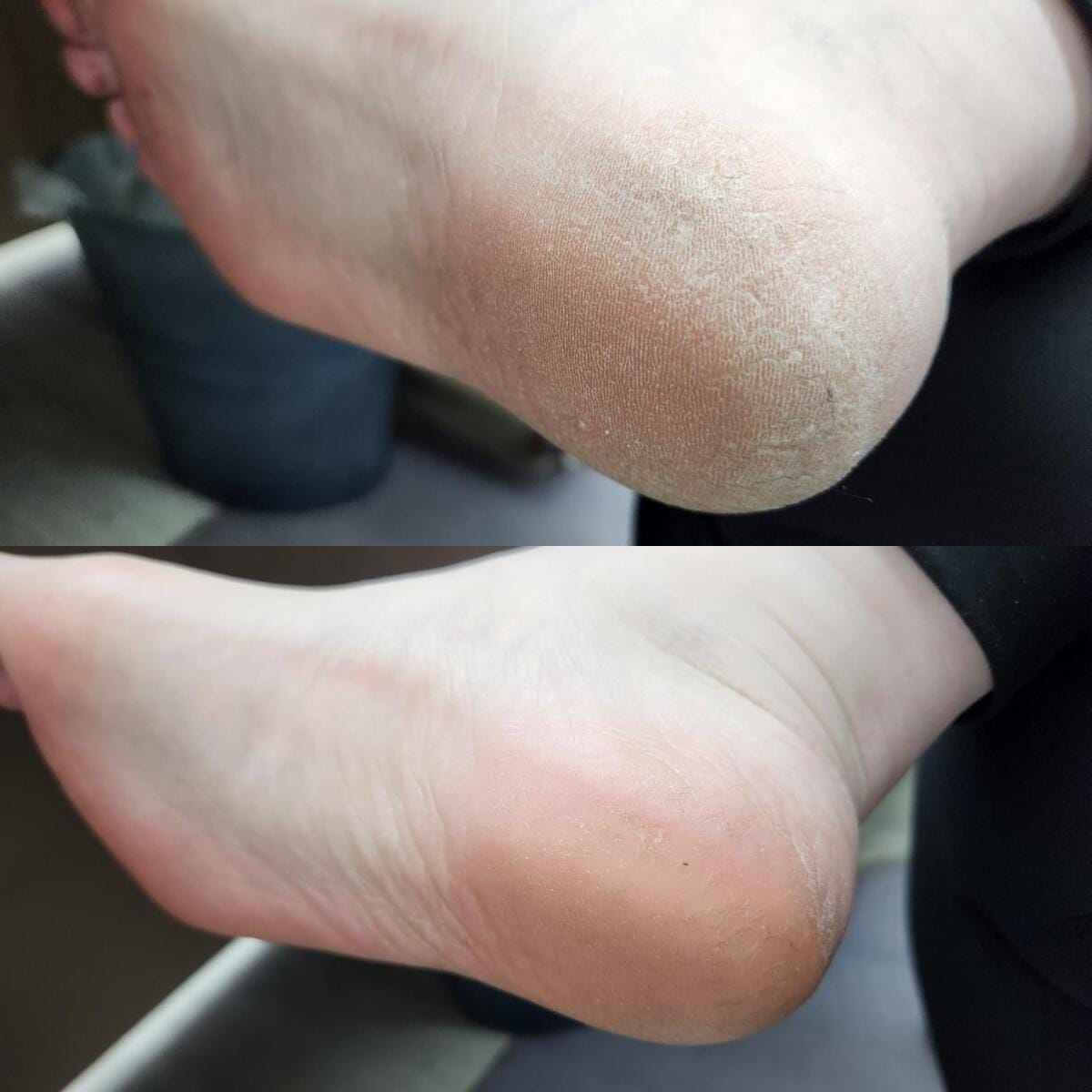 Customer photo review of Valanea SilkSmooth Pro™ Electric Foot Callus Remover