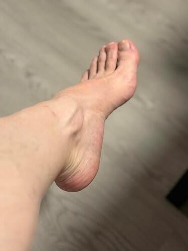 Customer photo review of Valanea SilkSmooth Pro™ Electric Foot Callus Remover