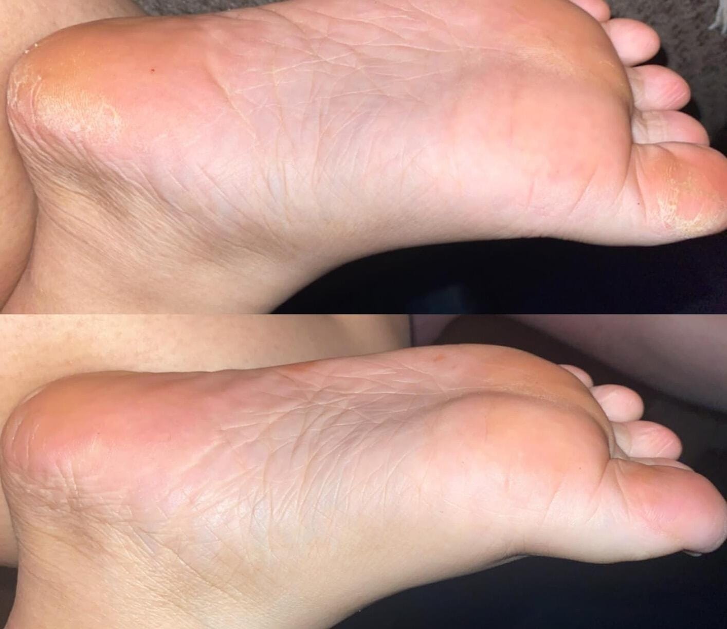 Customer photo review of Valanea SilkSmooth Pro™ Electric Foot Callus Remover