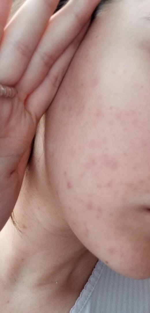 Customer photo review of Niacinamide 12% – ULTRA PURE · HIGH POTENCY