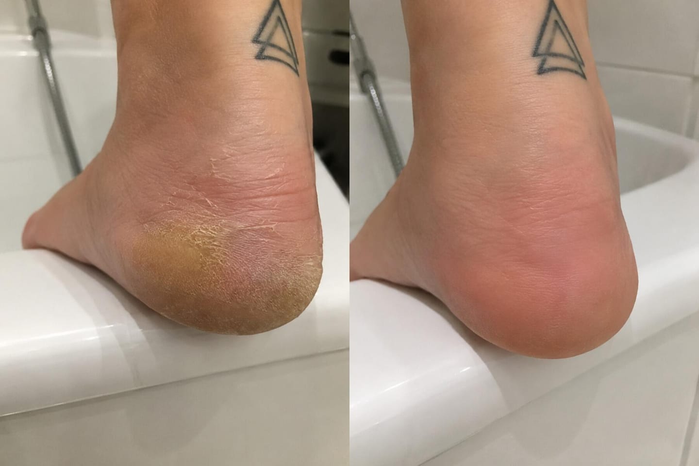 Customer photo review of Valanea SilkSmooth Pro™ Electric Foot Callus Remover