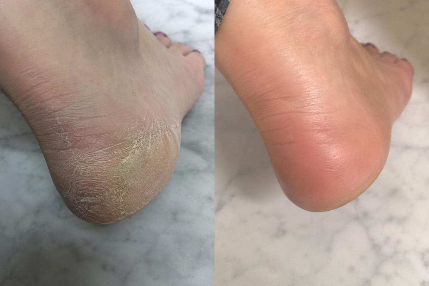 Customer photo review of Valanea SilkSmooth Pro™ Electric Foot Callus Remover