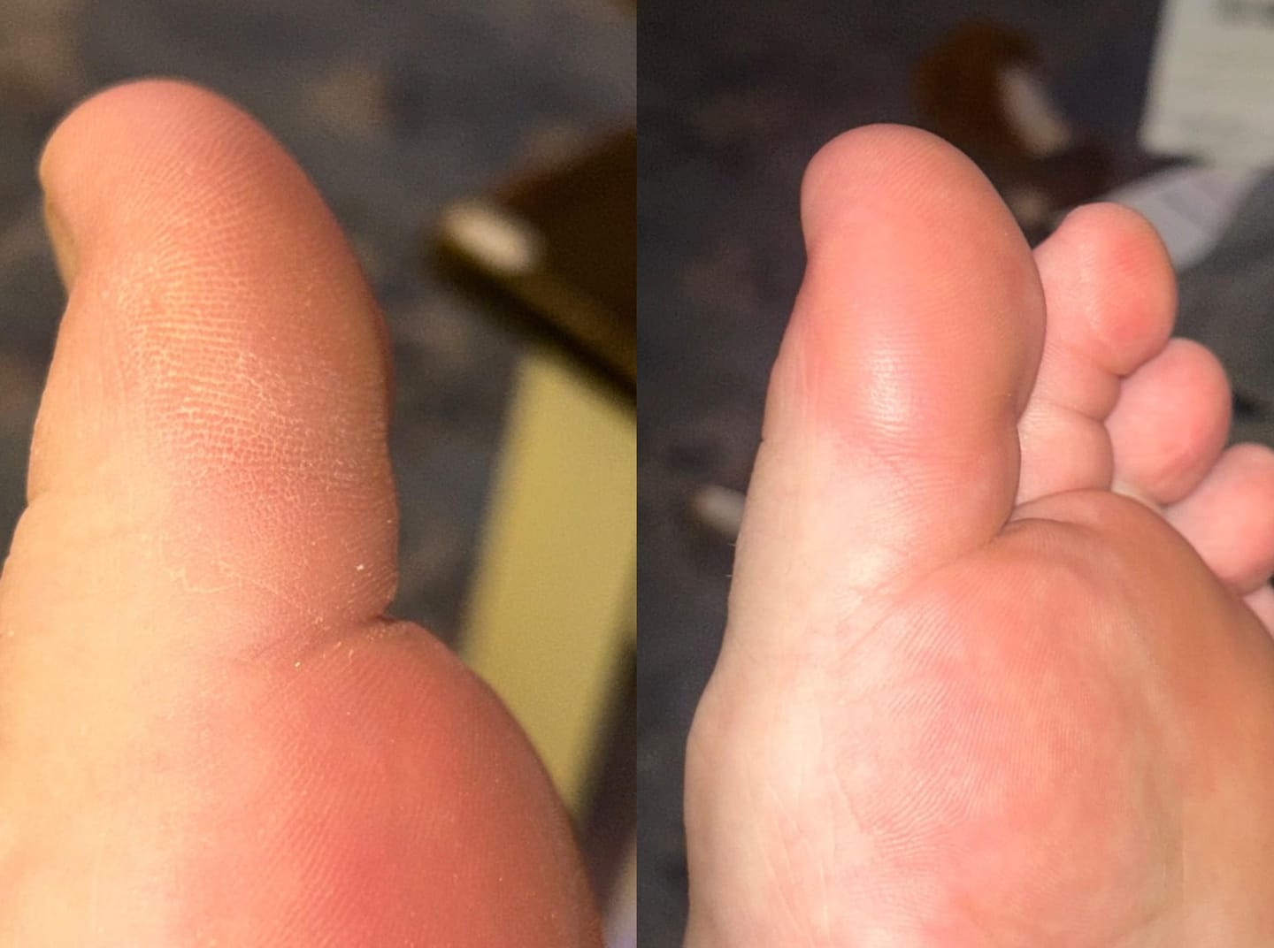 Customer photo review of Valanea SilkSmooth Pro™ Electric Foot Callus Remover