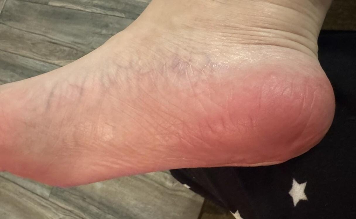Customer photo review of Valanea SilkSmooth Pro™ Electric Foot Callus Remover