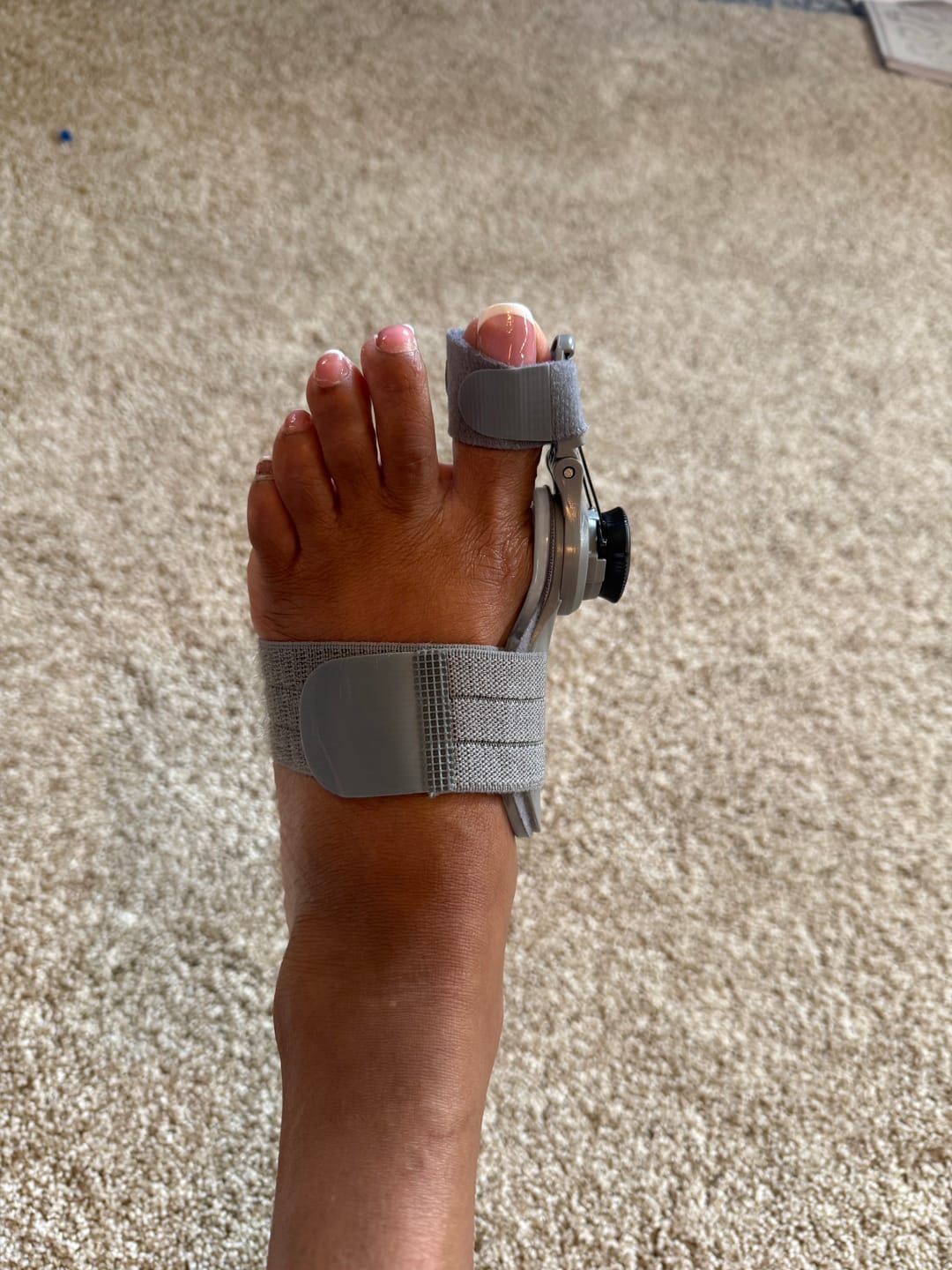 Customer photo review of Treatmedy™ Bunion Fix