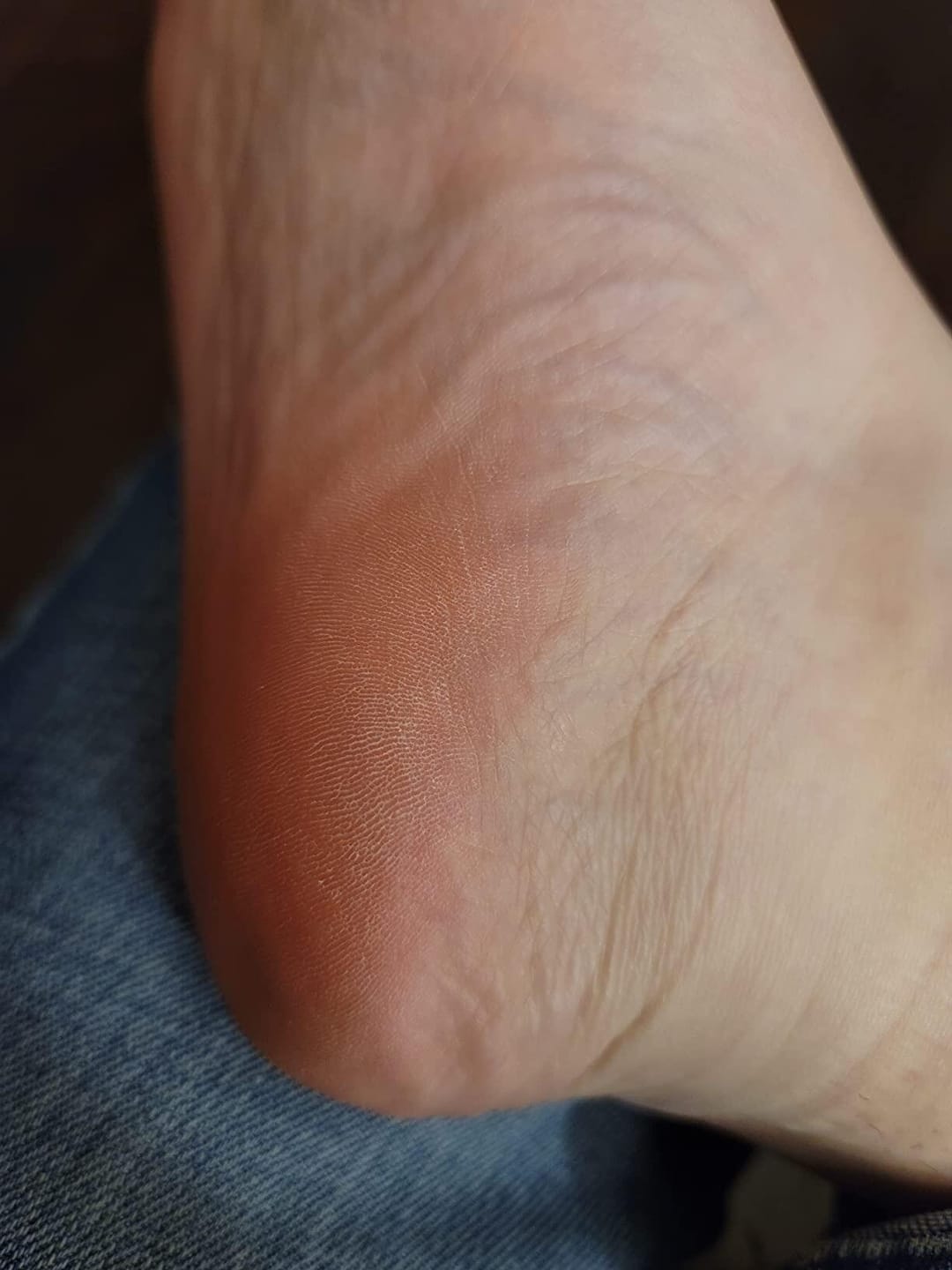 Customer photo review of Valanea SilkSmooth Pro™ Electric Foot Callus Remover