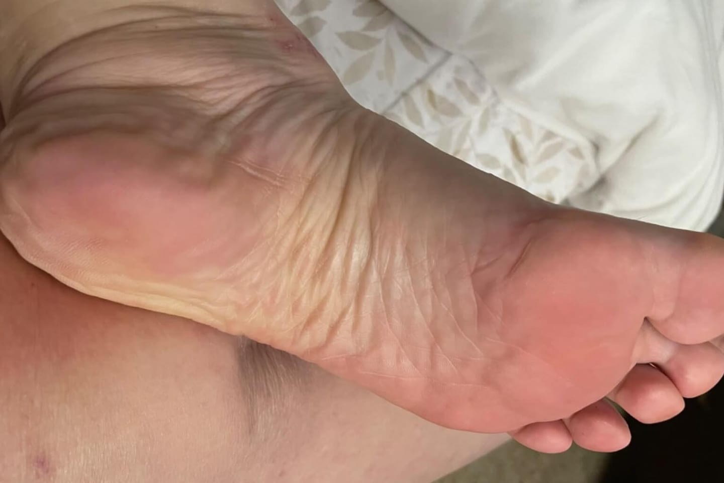 Customer photo review of Valanea SilkSmooth Pro™ Electric Foot Callus Remover