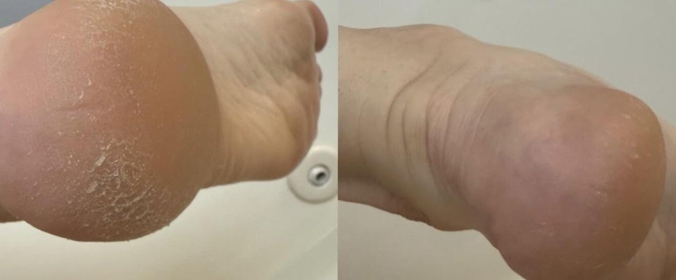 Customer photo review of Valanea SilkSmooth Pro™ Electric Foot Callus Remover