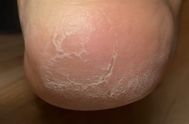 Customer photo review of Valanea SilkSmooth Pro™ Electric Foot Callus Remover
