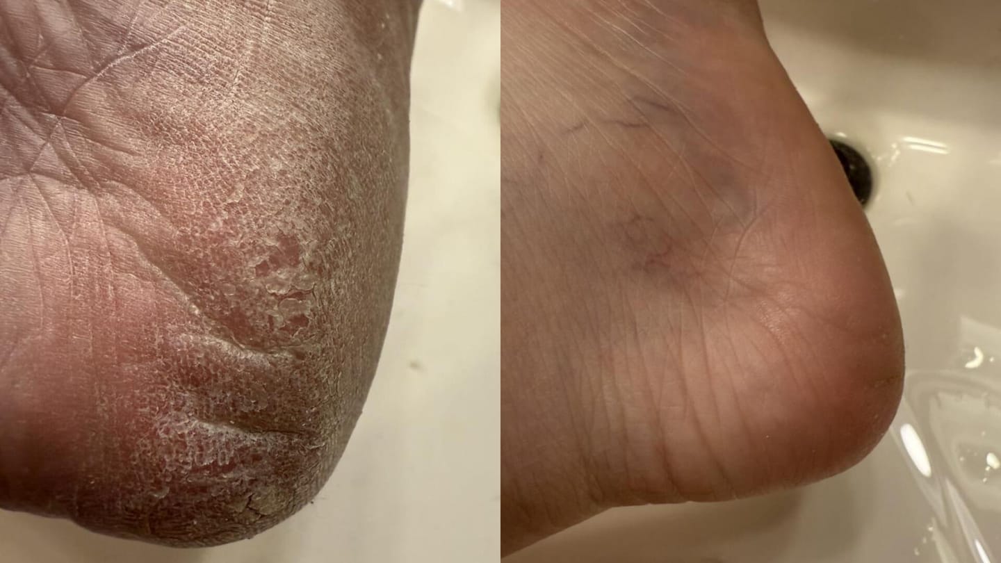 Customer photo review of Valanea SilkSmooth Pro™ Electric Foot Callus Remover