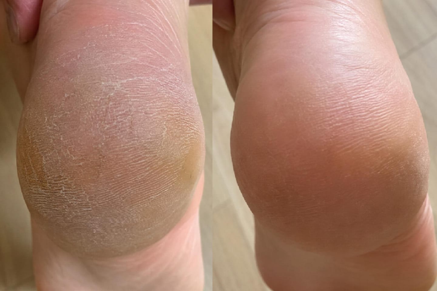 Customer photo review of Valanea SilkSmooth Pro™ Electric Foot Callus Remover