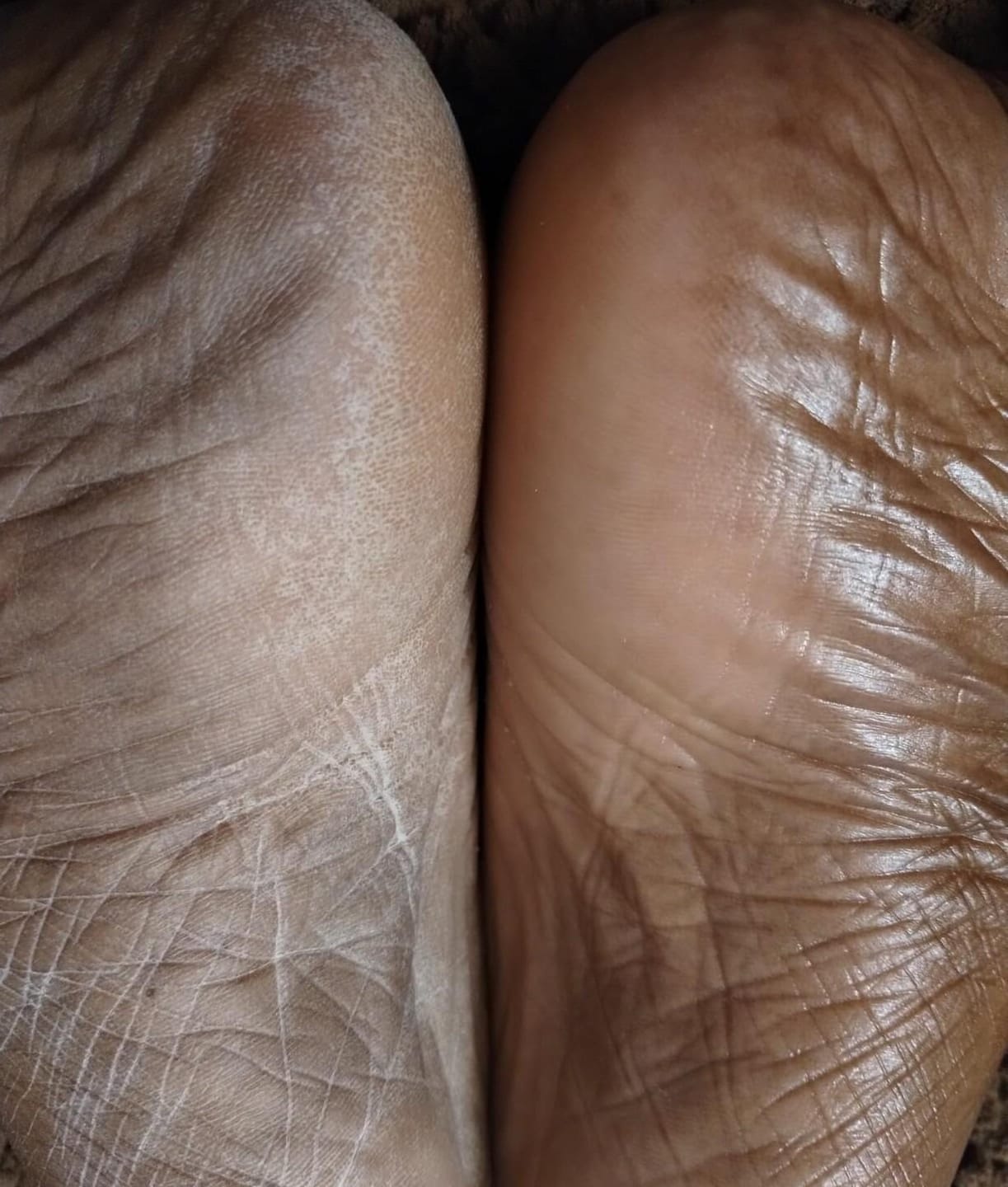 Customer photo review of Valanea SilkSmooth Pro™ Electric Foot Callus Remover