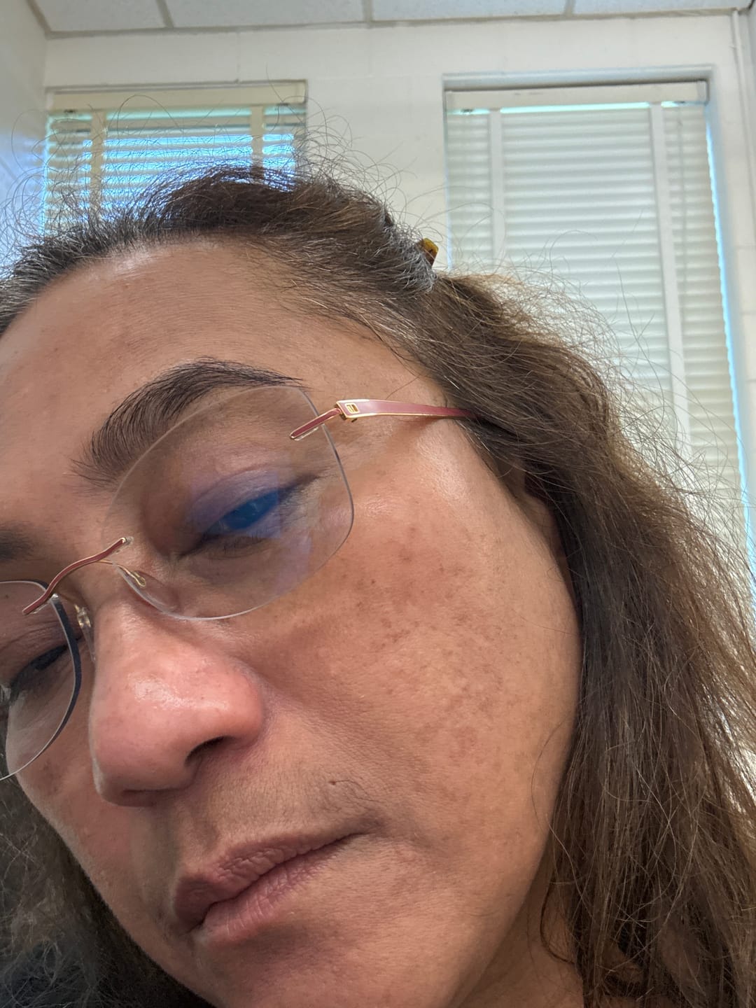 Customer photo review of Ventamin Light Up: Doctor-Formulated Brightening Formula for Melasma, Acne scars & Hyperpigmentation