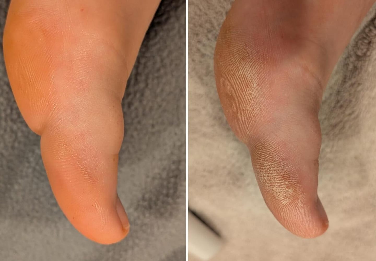 Customer photo review of Valanea SilkSmooth Pro™ Electric Foot Callus Remover