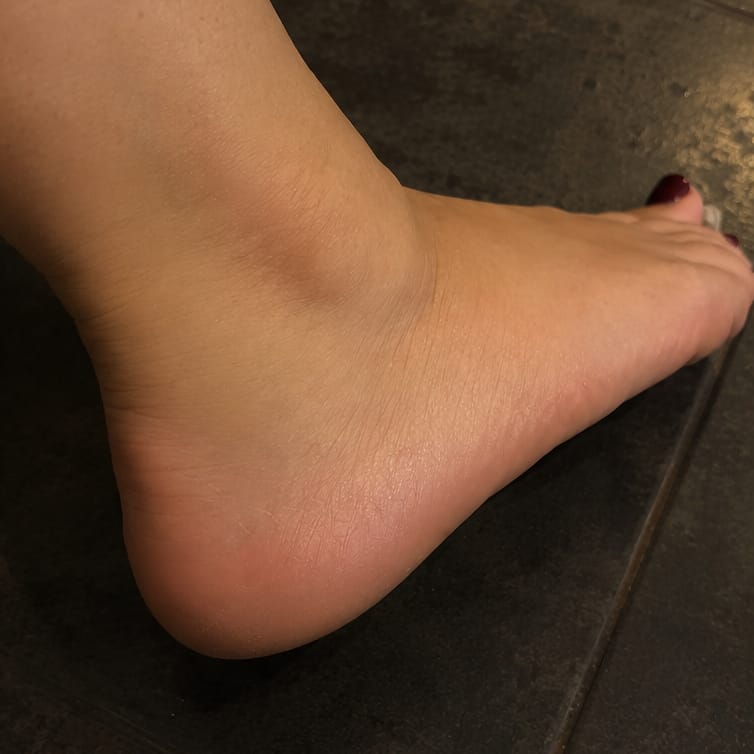 Customer photo review of Valanea SilkSmooth Pro™ Electric Foot Callus Remover