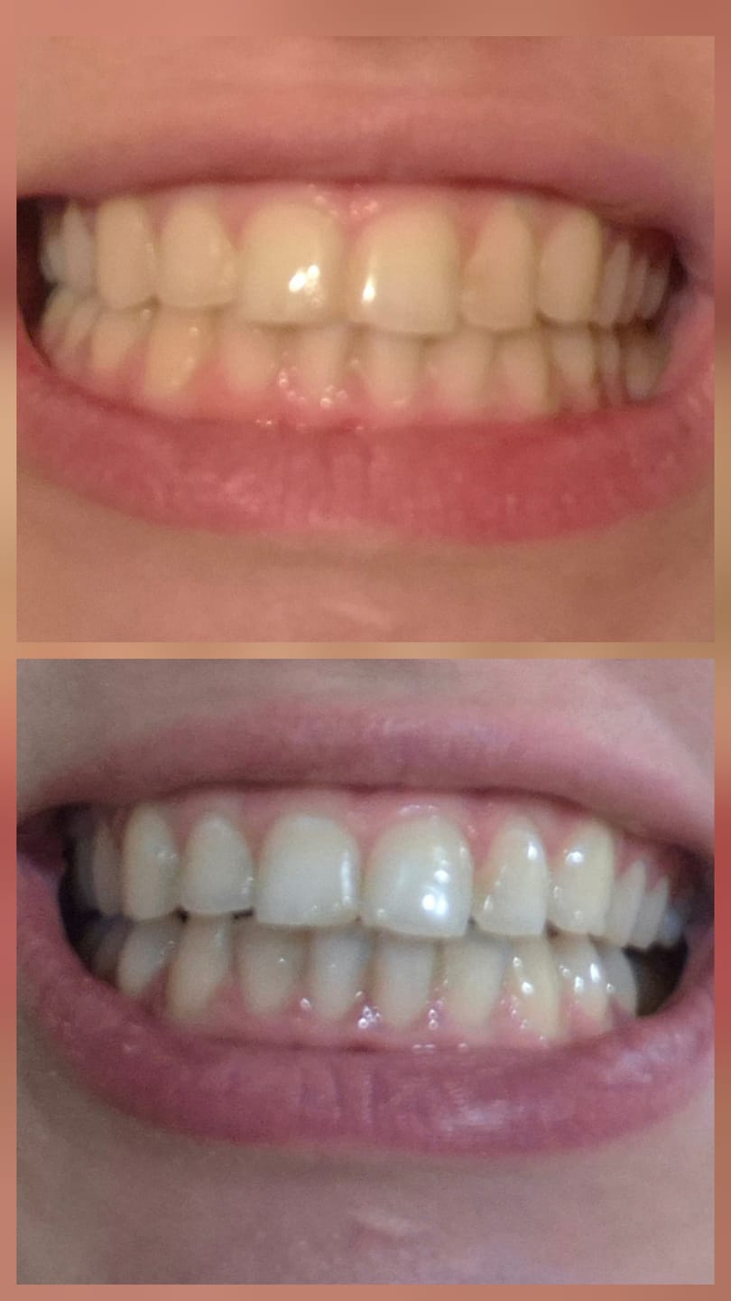 Customer photo review of V24 Violetinės Dantų Balinimo Juostelės