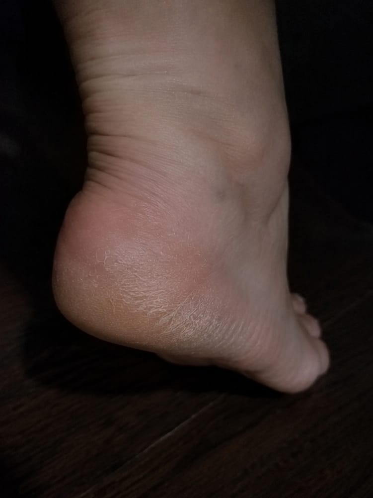 Customer photo review of Valanea SilkSmooth Pro™ Electric Foot Callus Remover