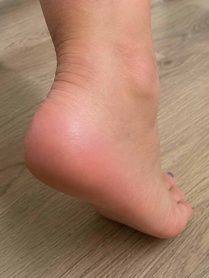 Customer photo review of Valanea SilkSmooth Pro™ Electric Foot Callus Remover