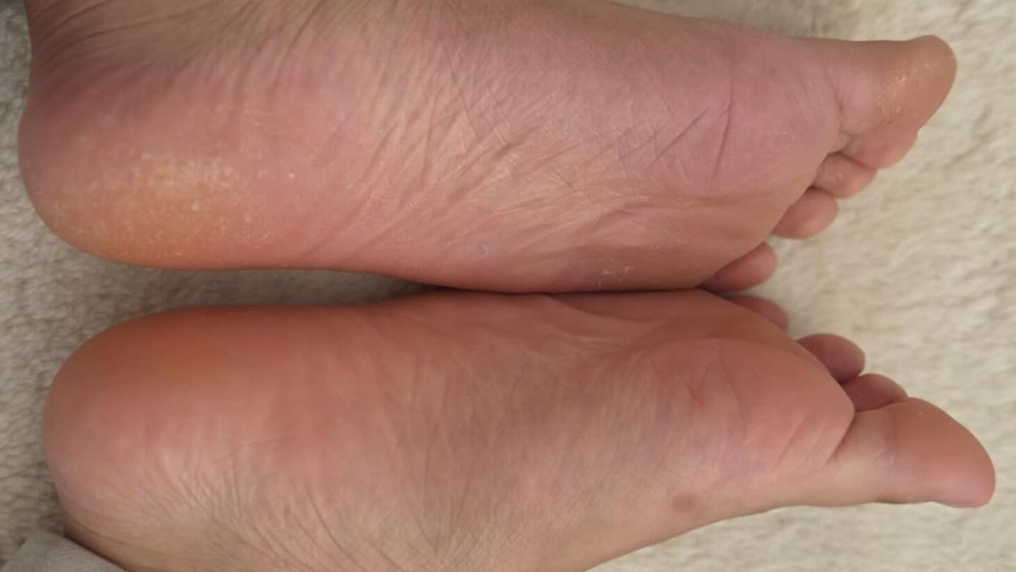 Customer photo review of Valanea SilkSmooth Pro™ Electric Foot Callus Remover