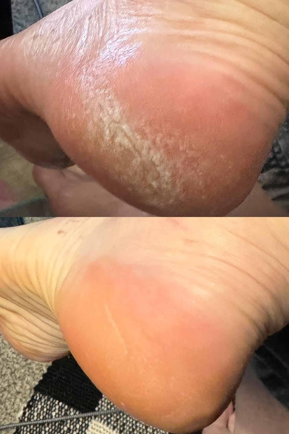 Customer photo review of Valanea SilkSmooth Pro™ Electric Foot Callus Remover