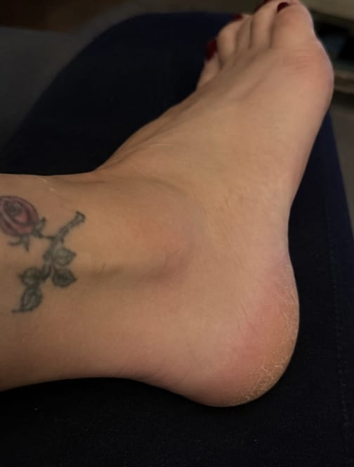 Customer photo review of Valanea SilkSmooth Pro™ Electric Foot Callus Remover