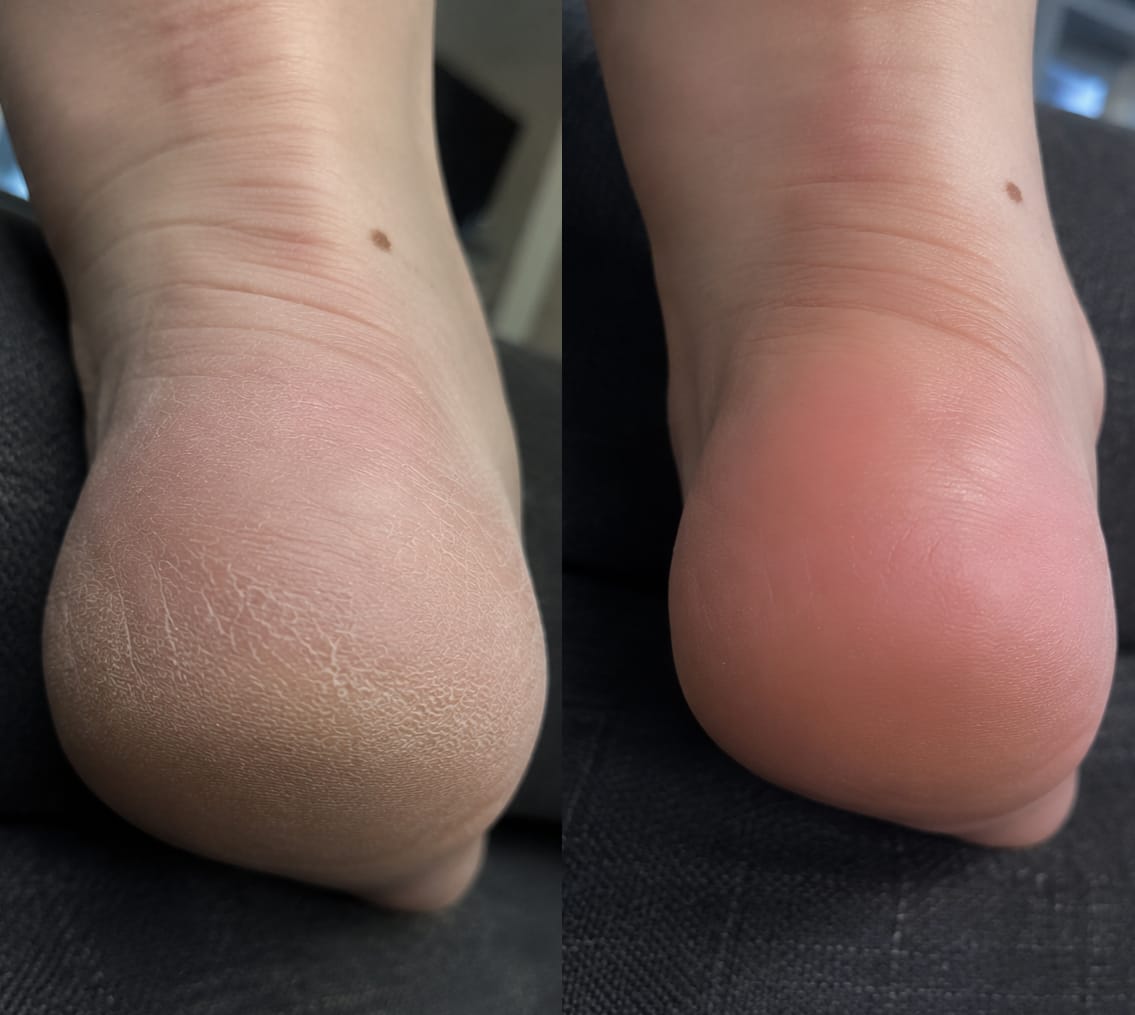 Customer photo review of Valanea SilkSmooth Pro™ Electric Foot Callus Remover