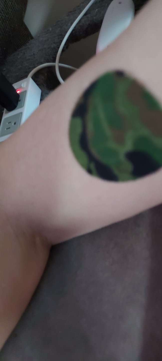 Customer photo review of Skin Grip Original - Libre 3+ Adhesive Patches