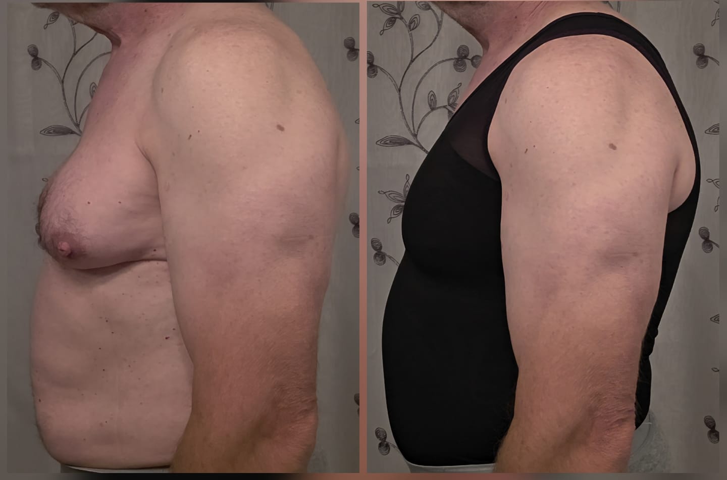 Customer photo review of Gynecomastia Compression Shirt for Men (the Original)
