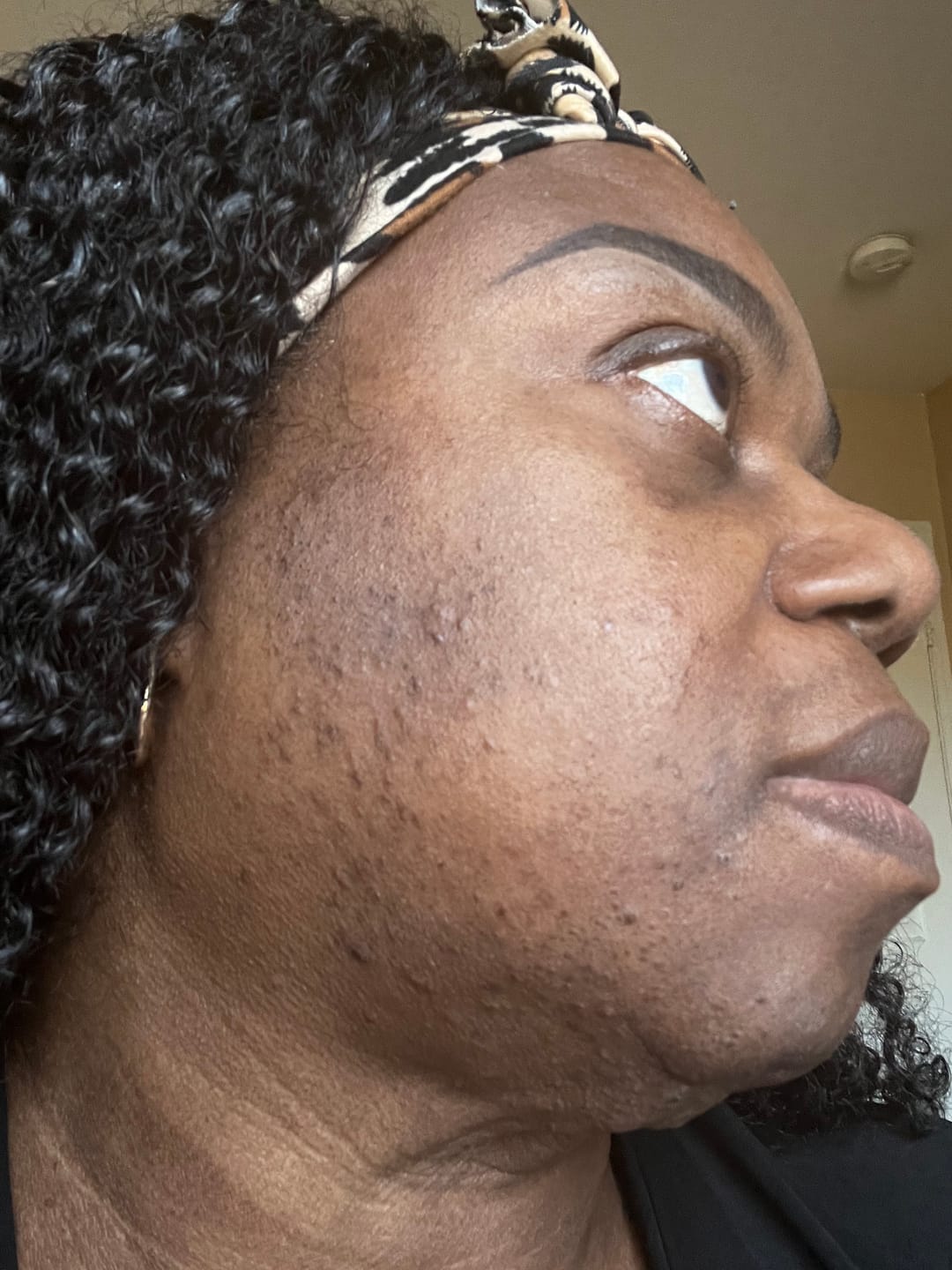 Customer photo review of Anti-Acne & Blemish Bar.