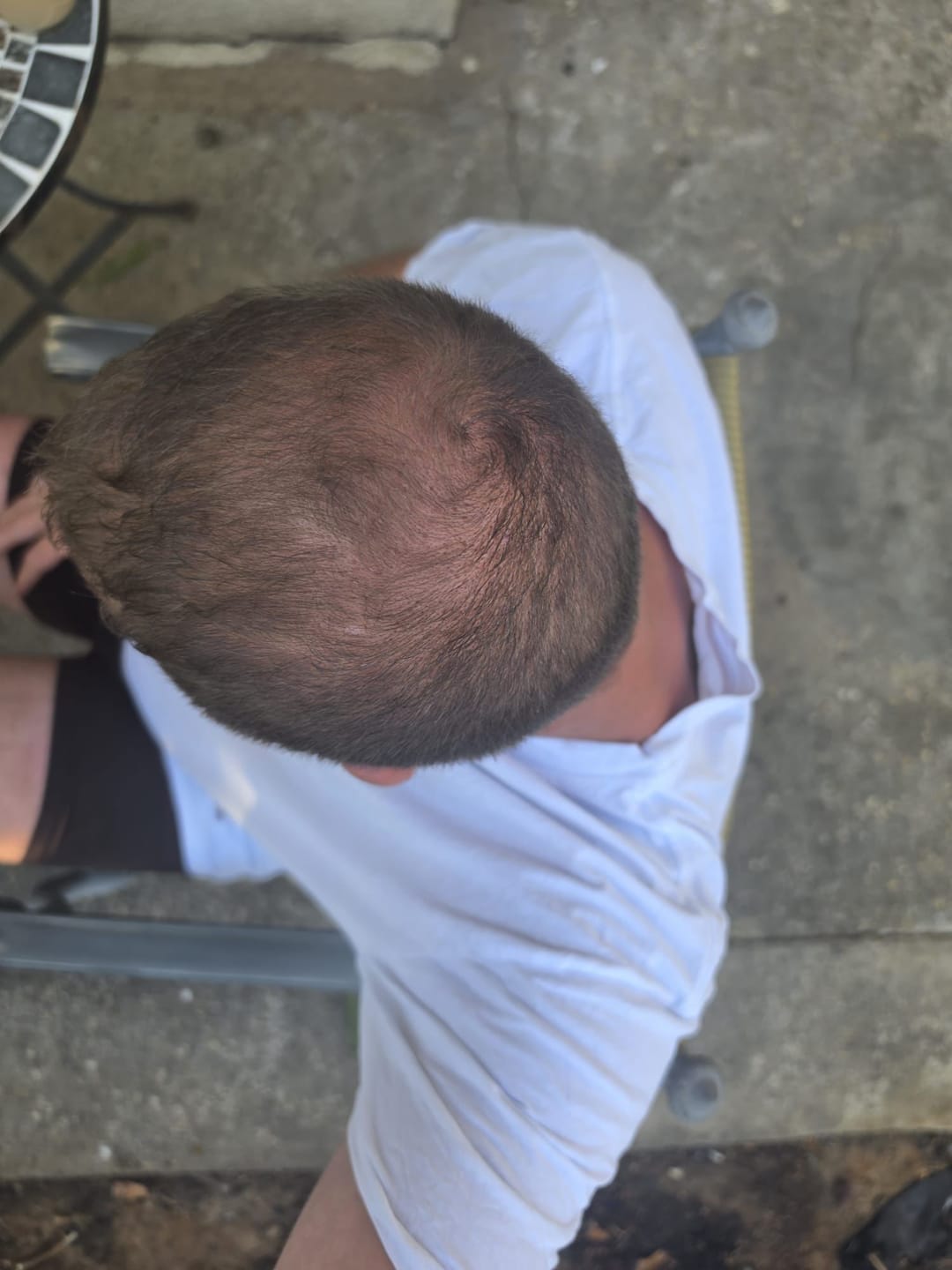Customer photo review of RootFix™ | ערכה לטיפול בנשירה והתקרחות של השיער