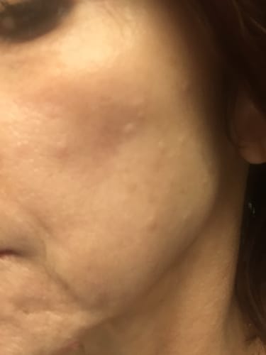 Close-up: Reviewer's cheek showing skin texture and tone during treatment with the Micro Infusion System.