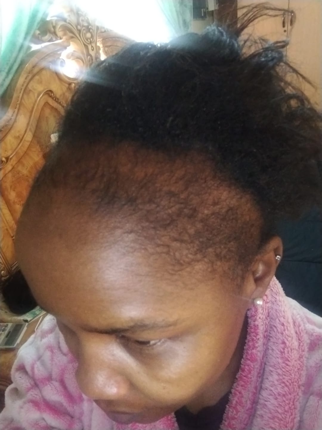 Customer photo review of Minoxidil 5% SOLUTION, 3 x 60ml pack