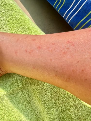 Customer's leg showing a red, bumpy rash before using Goji Glow to help clear it up.