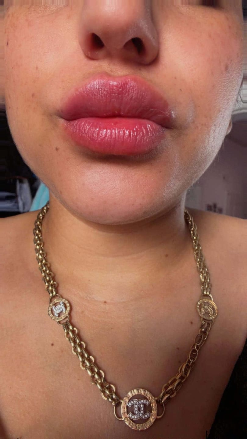 Customer photo review of Bellaré Lip Plumper