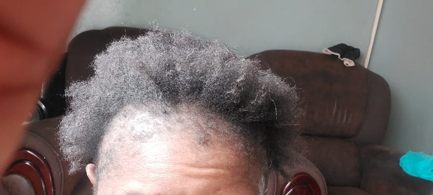 Customer photo review of Minoxidil REGULAR (2%) strength SOLUTION, 3month supply
